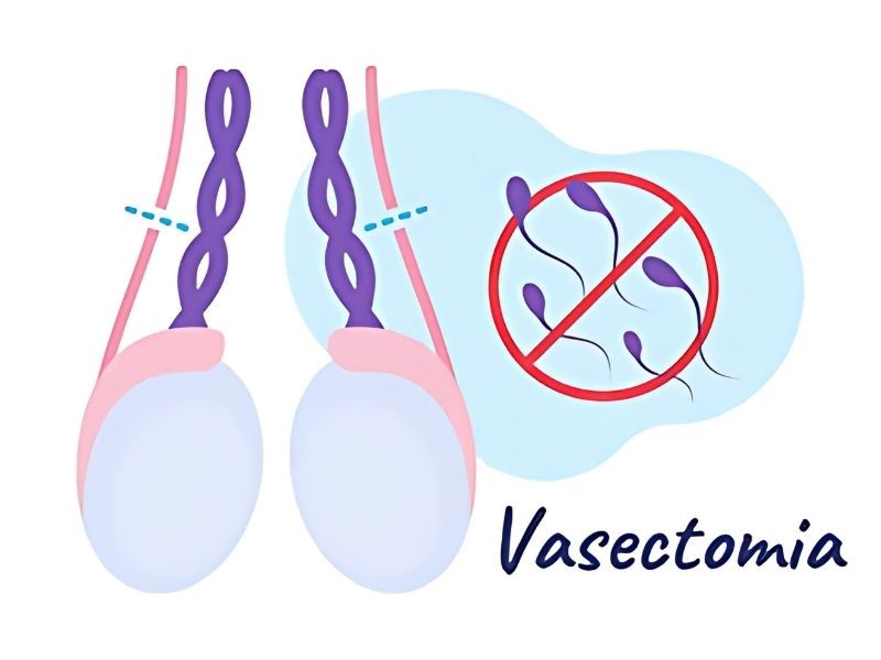 Vasectomia: cirurgia de esterilização masculina
