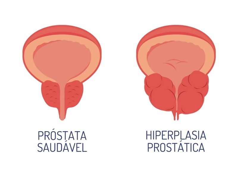 Hiperplasia Prostática Benigna: Você já ouviu falar?